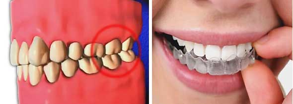 ภาพ สบฟัน ทำให้ฟันกัดกัน และยางป้องกันการนอนกัดฟัน