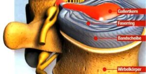 หมอนรองกระดูกเคลื่อน