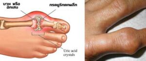 เก๊าท์gout
