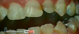 กลิ่นปากเหม็น