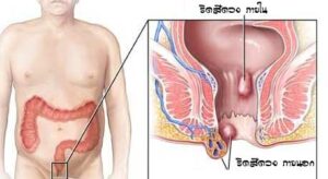 ริดสีดวง