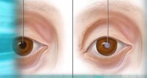 ต้อกระจก